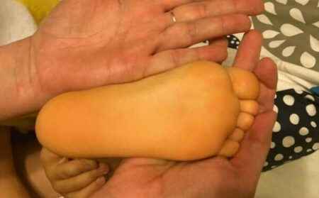 Болезнь Боткина у детей