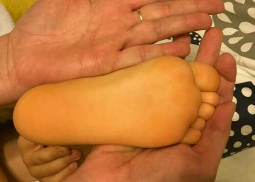 Болезнь Боткина у детей